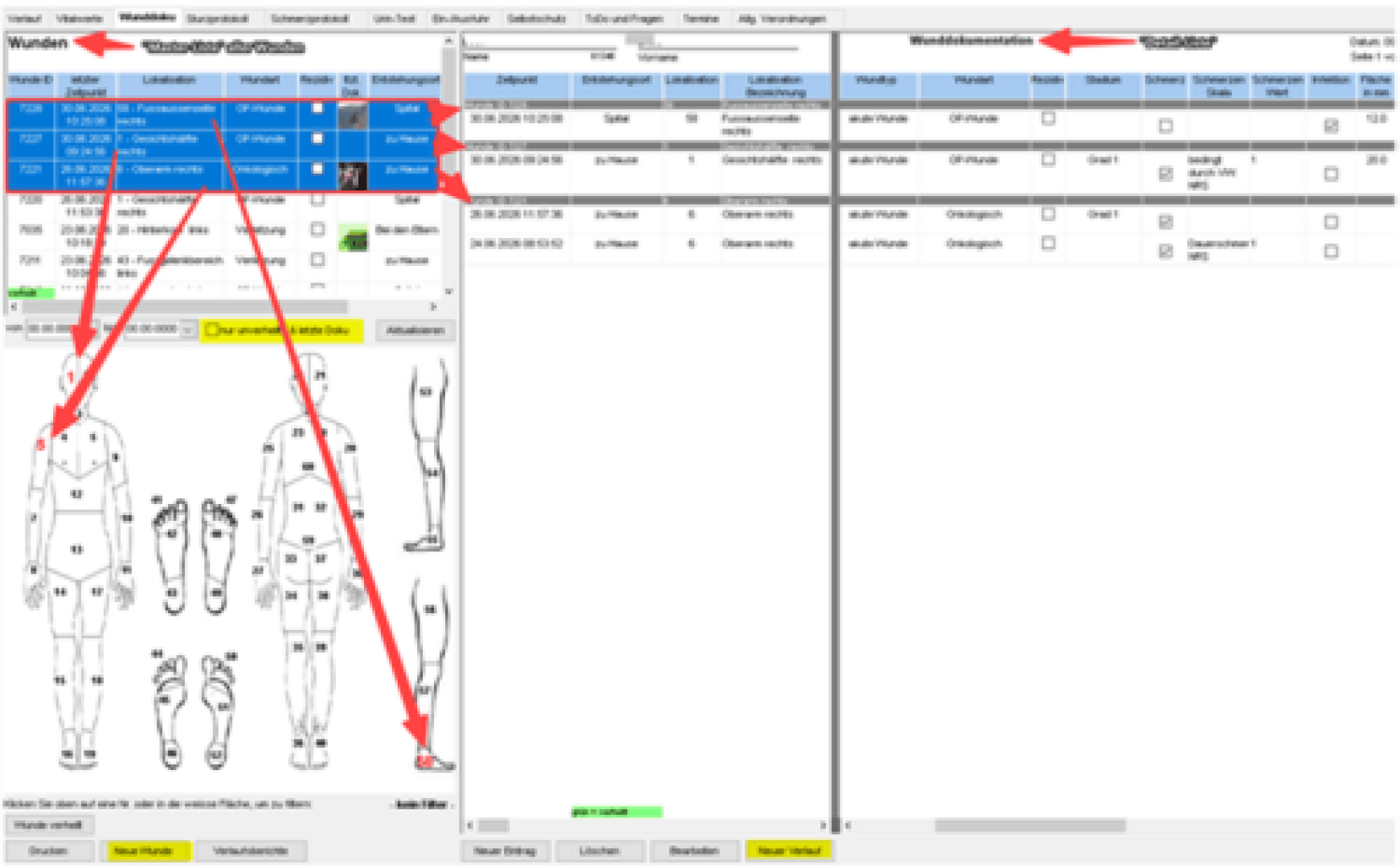 Screenshot der Benutzeroberfläche einer medizinischen Software mit einem Formular zur Wunddokumentation, mit roten Pfeilen markierten Körperdiagrammen, Listen mit Wunddetails und Tabellen mit Patienteninformationen auf Deutsch.